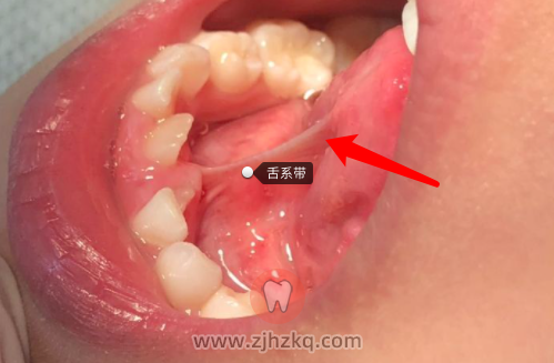 杭州儿童舌系带过短症状