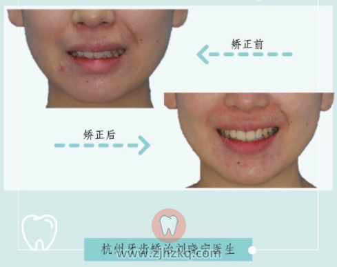 杭州隐适美二次矫正