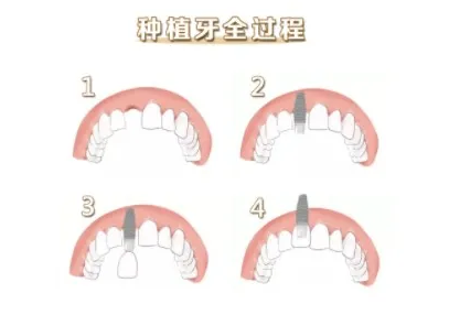 杭州种牙完整过程