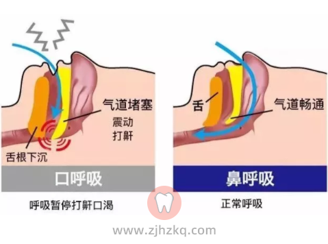 杭州口呼吸矫正