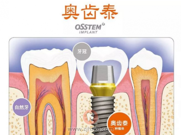 杭州奥齿泰种植牙价格