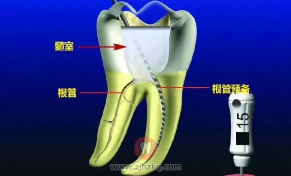 杭州根管治疗价格收费标准