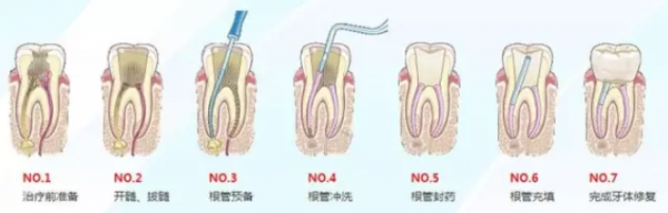 杭州根管治疗价格收费标准