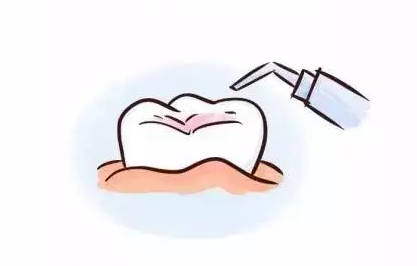 杭州窝沟封闭定点医院