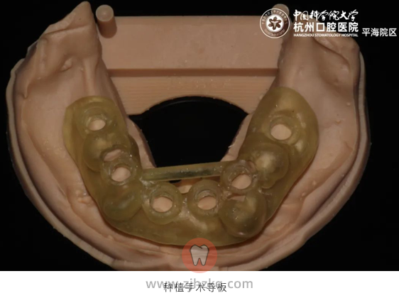杭州数字化微创种植