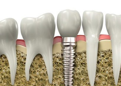 杭州国产种植牙价格表