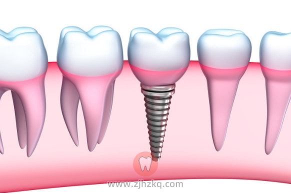 杭州种植牙术后注意事项