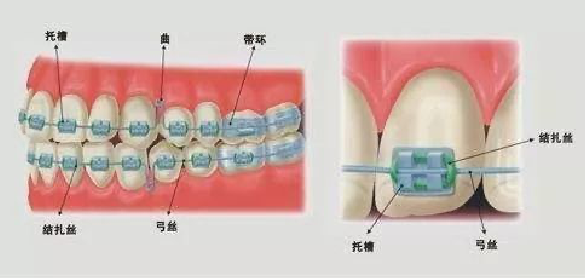 杭州钢丝牙套矫正
