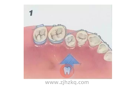 杭州钢丝牙套矫正