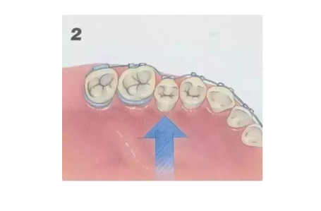杭州钢丝牙套矫正