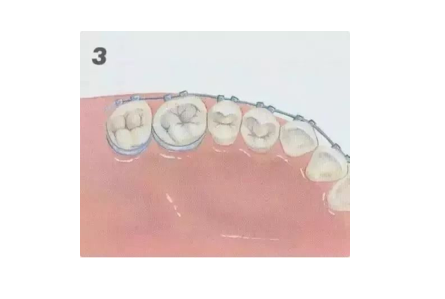 杭州钢丝牙套矫正