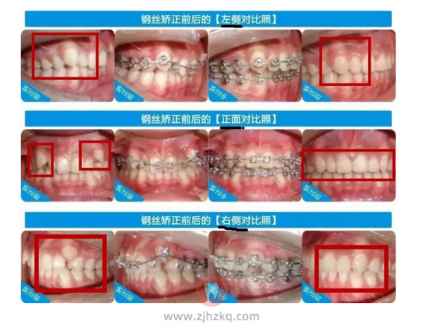 杭州钢丝牙套矫正
