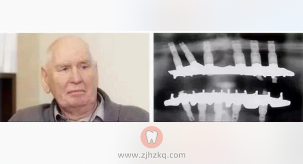 种植牙使用寿命多少年