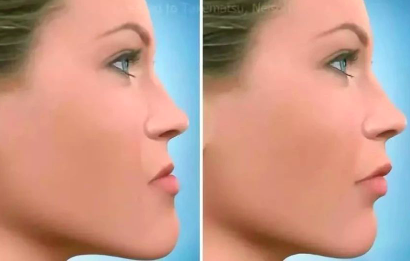 拔牙多久带牙套