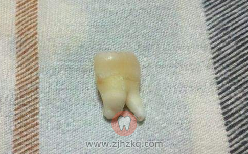 杭口城西拔智齿日记0630