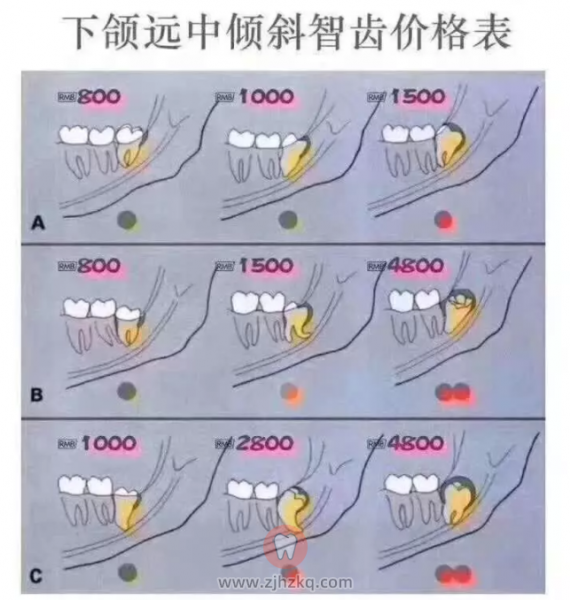 杭州拔智齿收费价格表