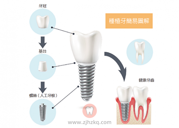 杭州口腔医院种植牙价格清单