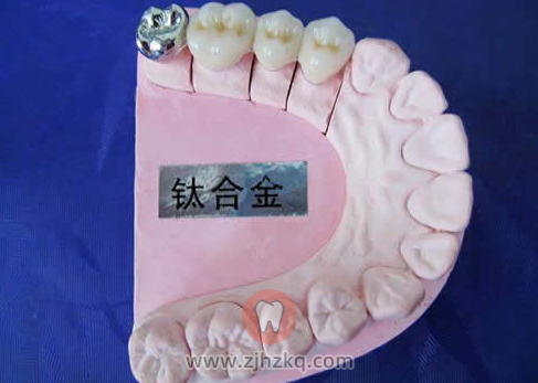 杭州烤瓷牙价格