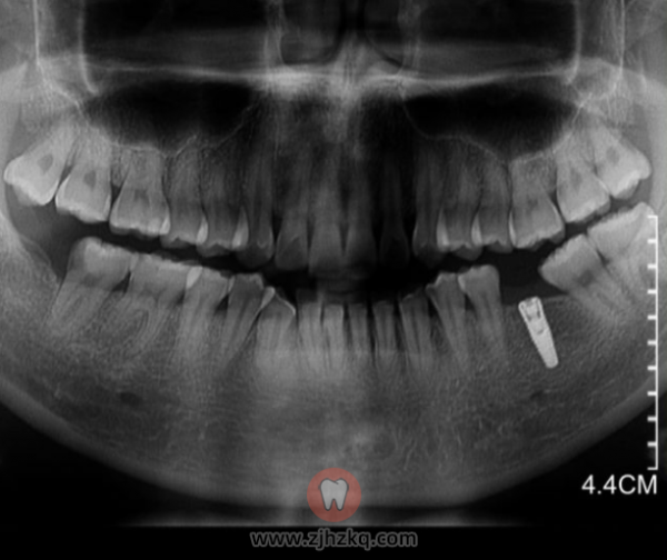 浙江**种牙记0825