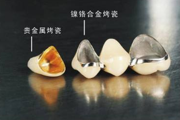 杭州牙冠品牌价格