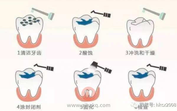 什么是窝沟封闭