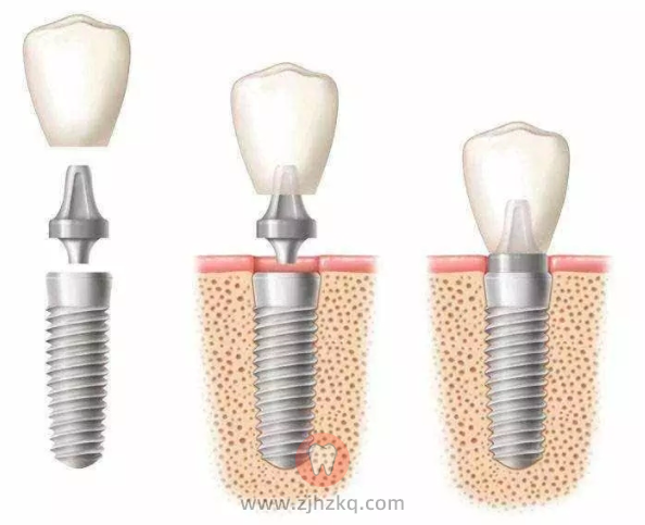 美国种植牙品牌价格表