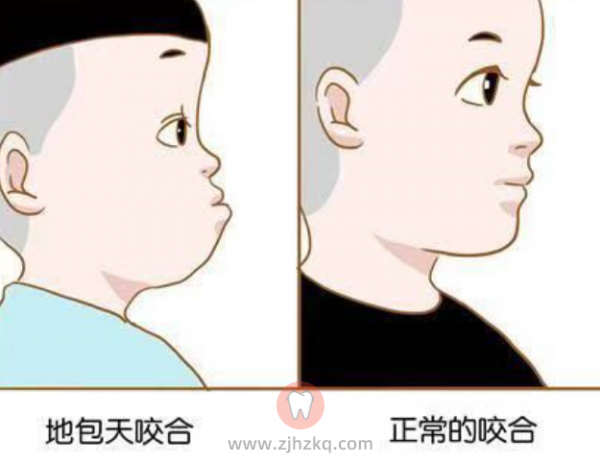 杭州地包天预防