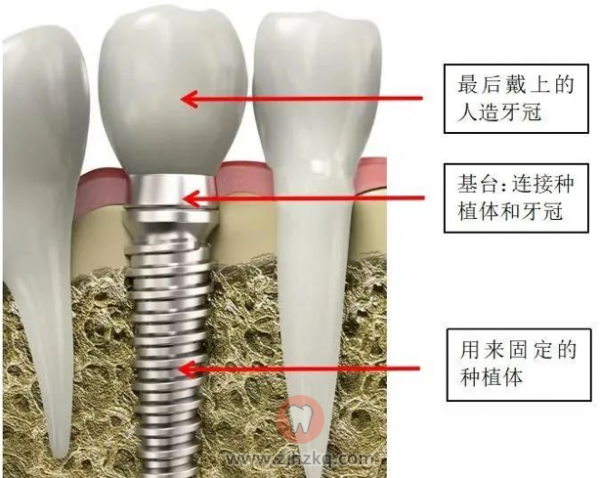 杭州种牙专家龚正伟说种植牙