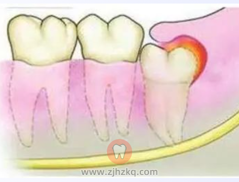 智齿牵引牙齿矫正