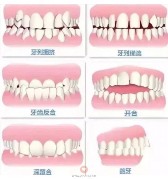 分享下矫正牙齿前注意事项