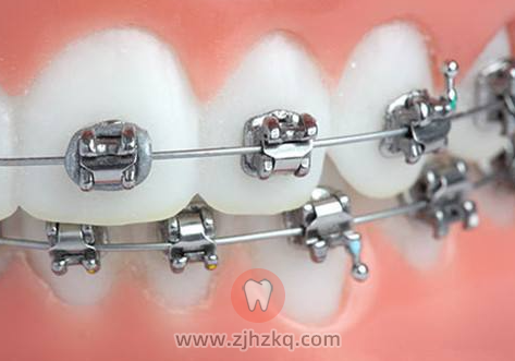 杭州市牙齿矫正价格