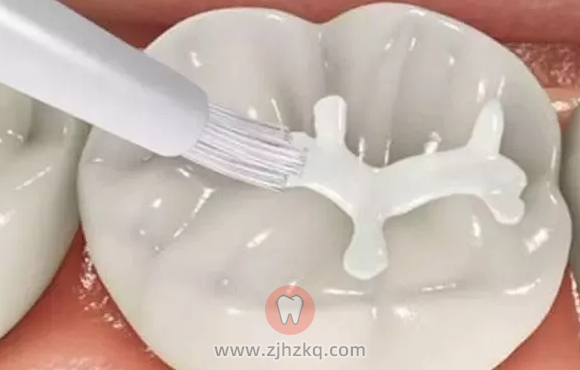 杭州窝沟封闭免费政策