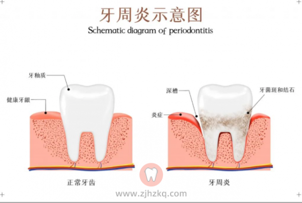 孕期牙周炎怎么办