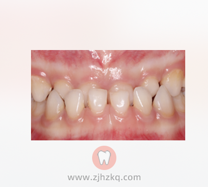 儿童牙齿矫正黄金期