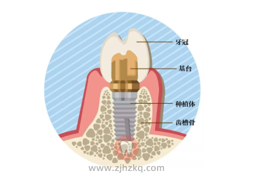 种植牙为什么这么贵？
