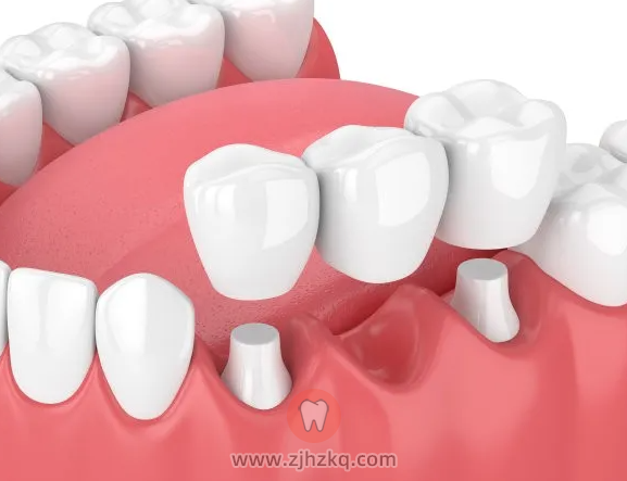 杭州固定假牙多少钱