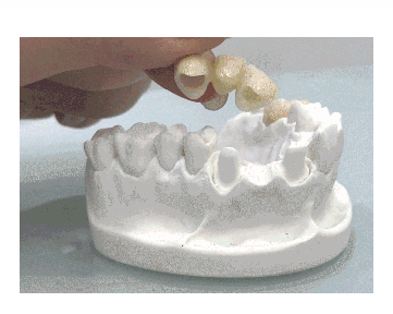 烤瓷牙真假辨别