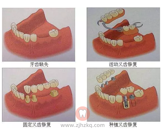 假牙种类假牙分为哪几种？