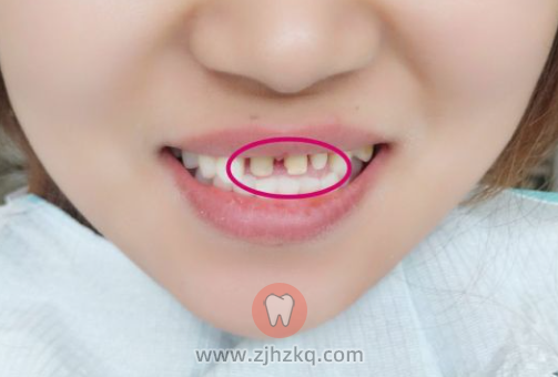全瓷牙套前后对比图