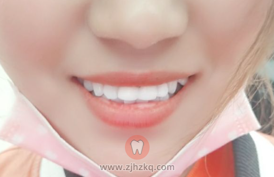 全瓷牙套前后对比图
