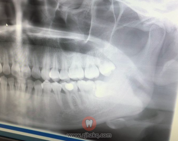 杭州口腔拔智齿日记1004
