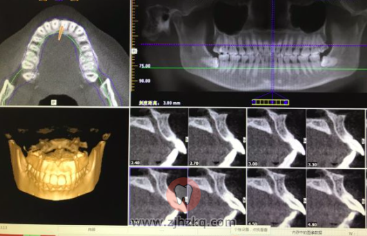 杭州博凡齿科拔智齿日记1205