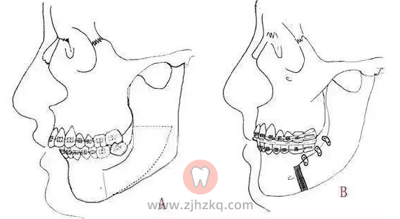 杭州牙齿矫正如何缩短正畸治疗时间？