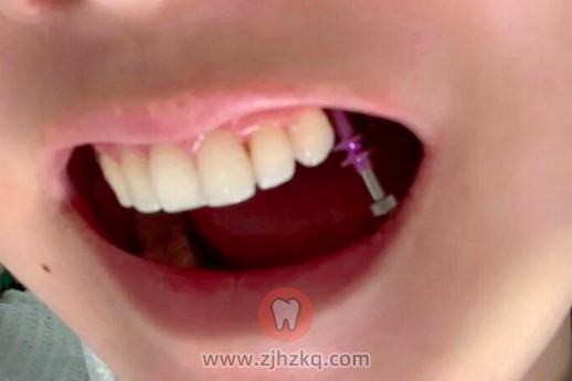 杭州萧山牙科医院种植牙日记1203