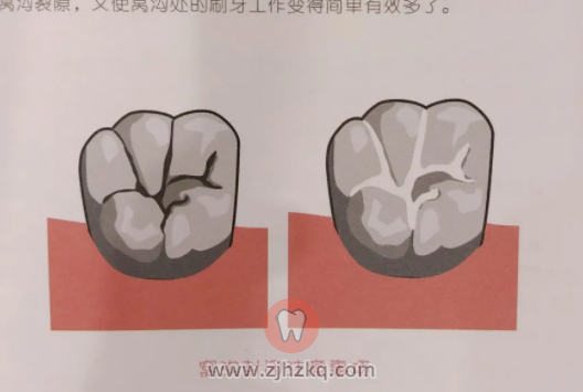 杭州儿童窝沟封闭免费