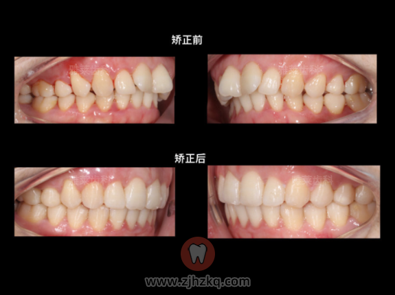 杭州雅莱齿科正畸案例
