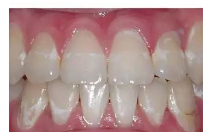 杭州牙齿矫正后如何预防白斑