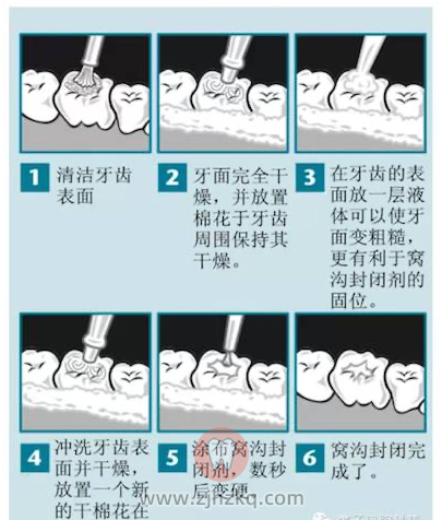 窝沟封闭示意图