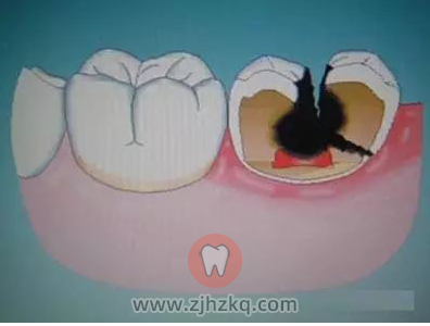 如何避免发生蛀牙？