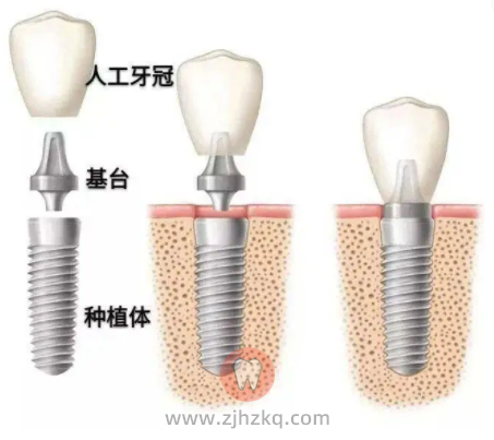 杭州种植牙品牌及价格区间表